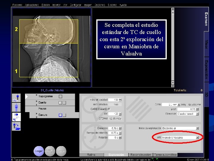 2 1 Se completa el estudio estándar de TC de cuello con esta 2ª