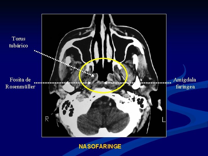 Torus tubárico Fosita de Rosenmüller Amígdala faríngea NASOFARINGE 