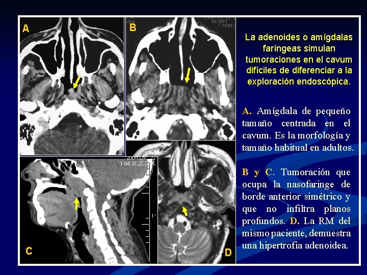 A B La adenoides o amígdalas faríngeas simulan tumoraciones en el cavum difíciles de