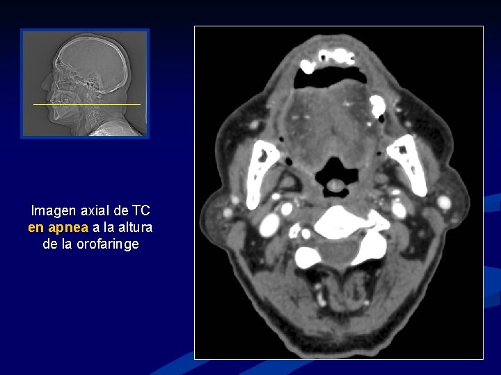 Imagen axial de TC en apnea a la altura de la orofaringe 