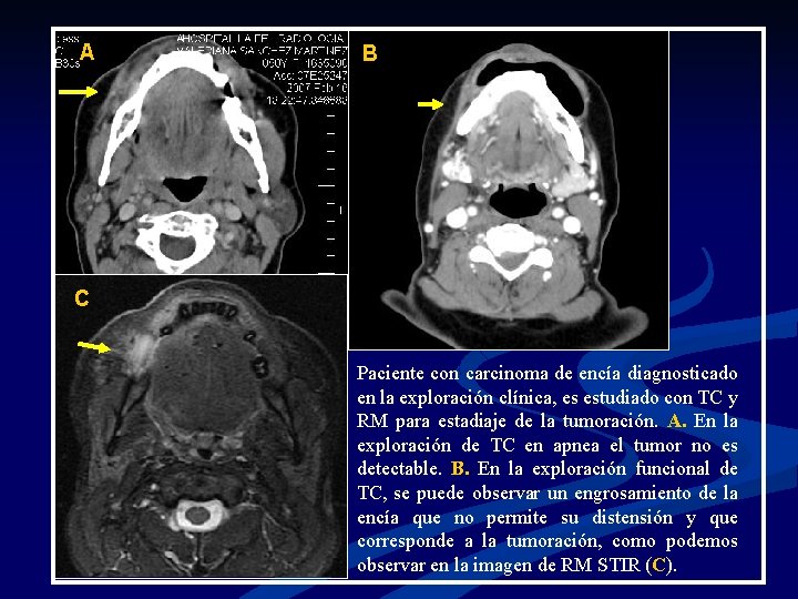 A B C Paciente con carcinoma de encía diagnosticado en la exploración clínica, es