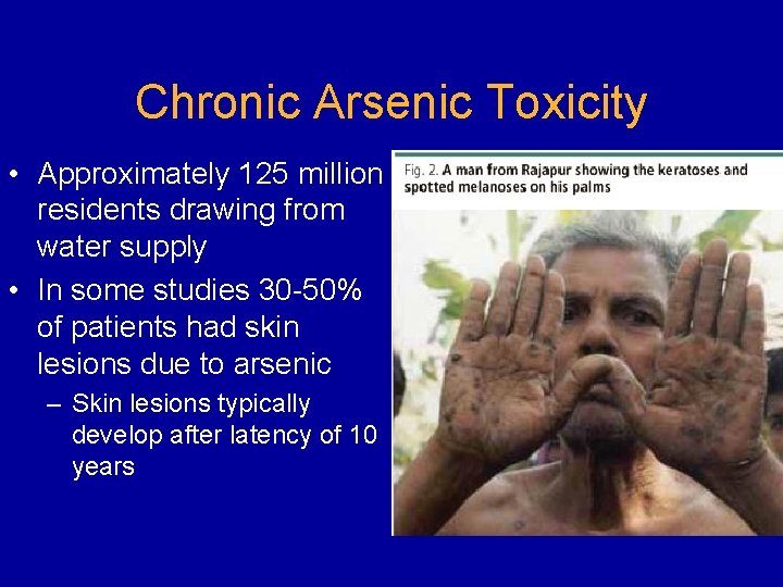 Chronic Arsenic Toxicity • Approximately 125 million residents drawing from water supply • In