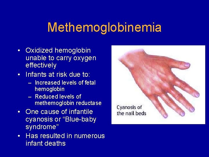Methemoglobinemia • Oxidized hemoglobin unable to carry oxygen effectively • Infants at risk due