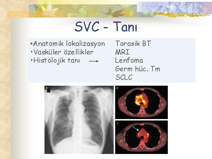 SVC - Tanı • Anatomik lokalizasyon • Vasküler özellikler • Histolojik tanı Torasik BT