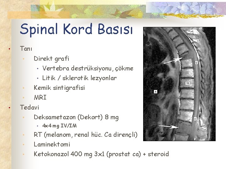 Spinal Kord Basısı • Tanı • • Direkt grafi • Vertebra destrüksiyonu, çökme •