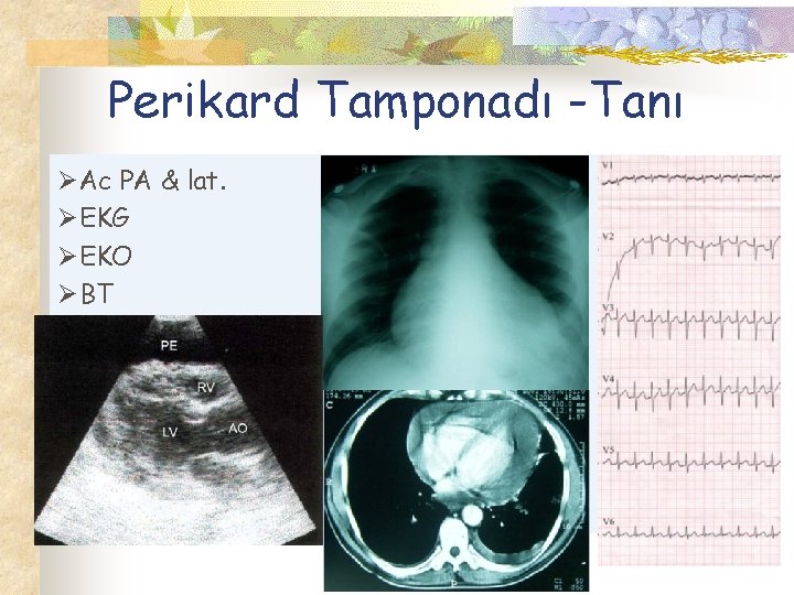 Perikard Tamponadı -Tanı ØAc PA & lat. ØEKG ØEKO ØBT 