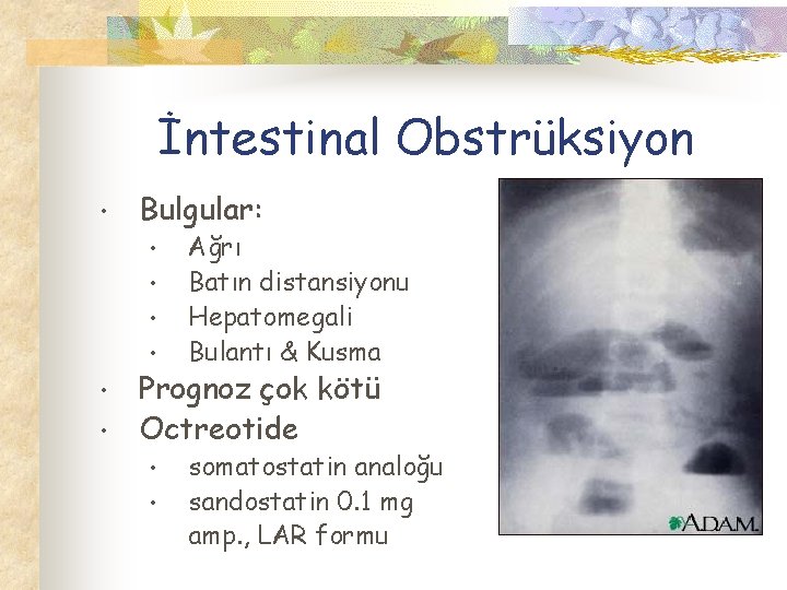 İntestinal Obstrüksiyon • Bulgular: • • • Ağrı Batın distansiyonu Hepatomegali Bulantı & Kusma