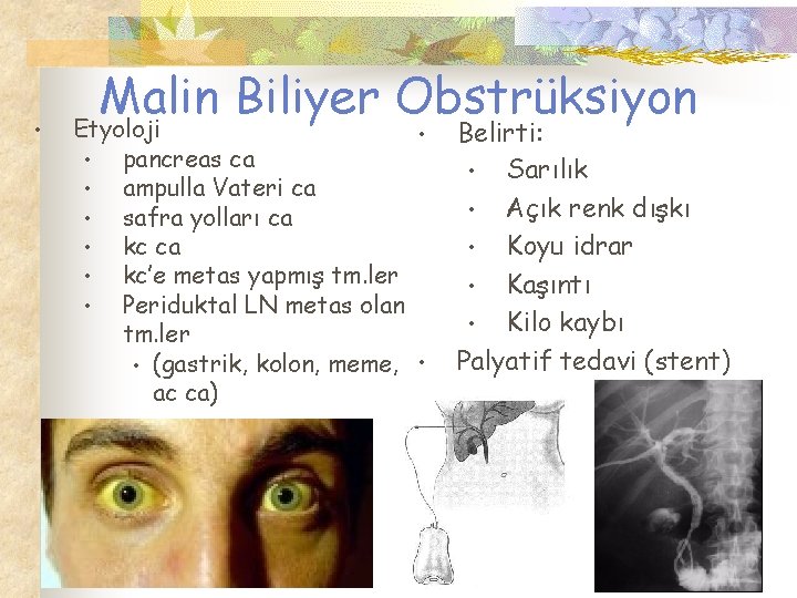  • Malin Biliyer Obstrüksiyon Etyoloji • • pancreas ca • ampulla Vateri ca