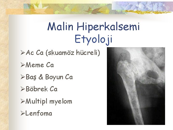 Malin Hiperkalsemi Etyoloji ØAc Ca (skuamöz hücreli) ØMeme Ca ØBaş & Boyun Ca ØBöbrek