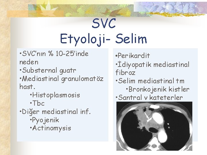 SVC Etyoloji- Selim • SVC’nın % 10 -25’inde neden • Substernal guatr • Mediastinal