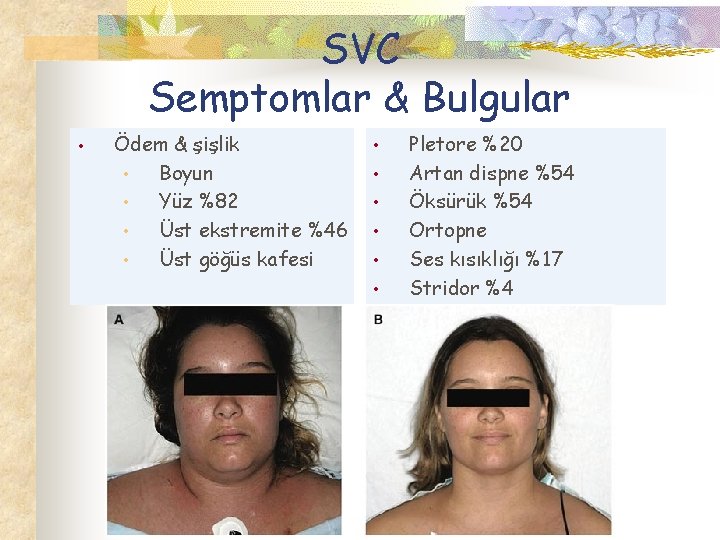 SVC Semptomlar & Bulgular • Ödem & şişlik • Boyun • Yüz %82 •