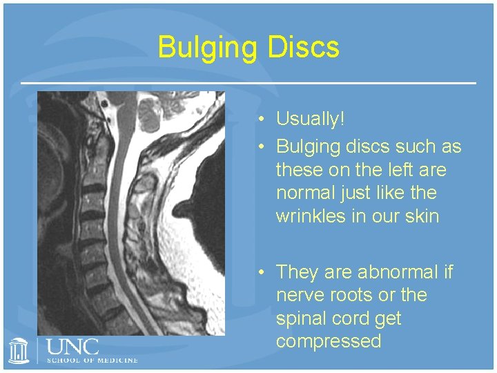 Bulging Discs • Usually! • Bulging discs such as these on the left are