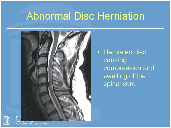 Abnormal Disc Herniation • Herniated disc causing compression and swelling of the spinal cord