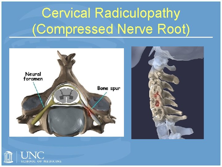 Cervical Radiculopathy (Compressed Nerve Root) 