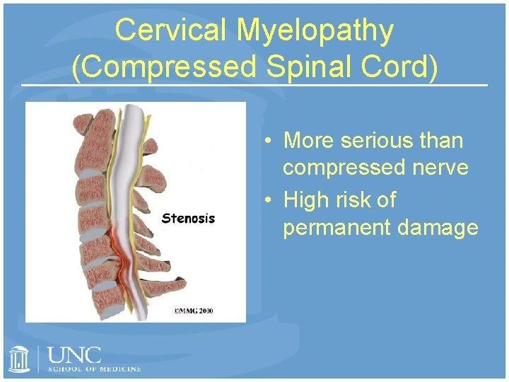 Cervical Myelopathy (Compressed Spinal Cord) • More serious than compressed nerve • High risk