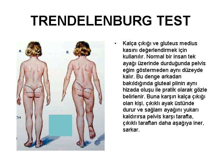 TRENDELENBURG TEST • Kalça çıkığı ve gluteus medius kasını değerlendirmek için kullanılır. Normal bir