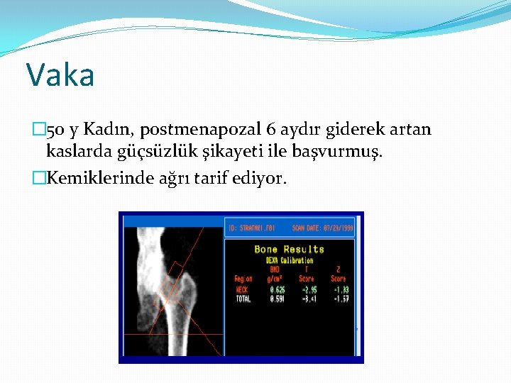 Vaka � 50 y Kadın, postmenapozal 6 aydır giderek artan kaslarda güçsüzlük şikayeti ile