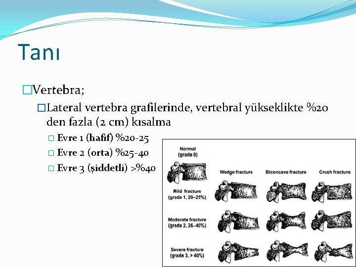 Tanı �Vertebra; �Lateral vertebra grafilerinde, vertebral yükseklikte %20 den fazla (2 cm) kısalma �