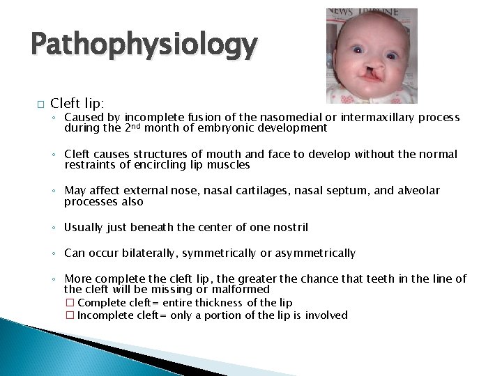 Pathophysiology � Cleft lip: ◦ Caused by incomplete fusion of the nasomedial or intermaxillary