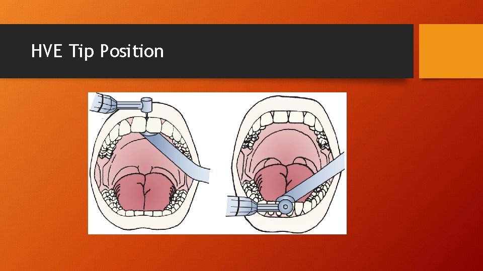 HVE Tip Position 