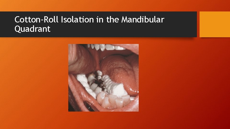 Cotton-Roll Isolation in the Mandibular Quadrant 