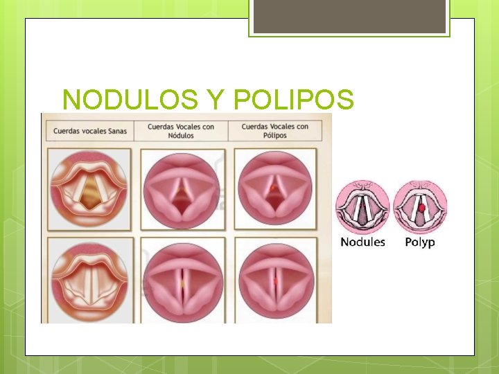 NODULOS Y POLIPOS NODULOS Y POLIPOS