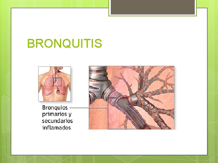 BRONQUITIS BRONQUITIS
