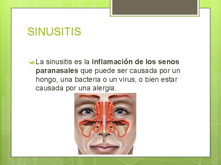 SINUSITIS La sinusitis es la inflamación de los senos paranasales que puede ser causada SINUSITIS La sinusitis es la inflamación de los senos paranasales que puede ser causada