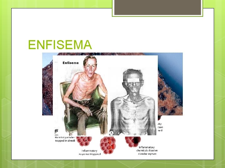 ENFISEMA ENFISEMA