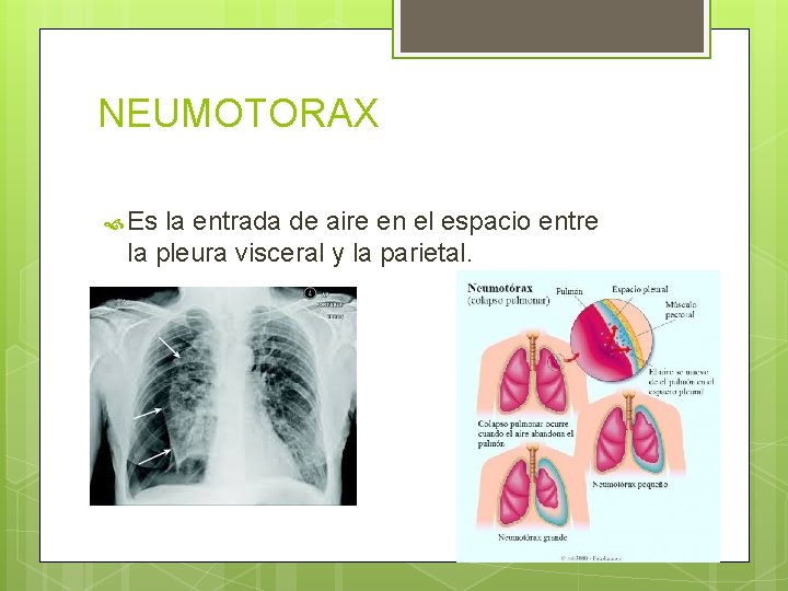 NEUMOTORAX Es la entrada de aire en el espacio entre la pleura visceral y NEUMOTORAX Es la entrada de aire en el espacio entre la pleura visceral y