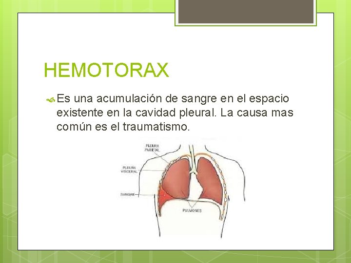 HEMOTORAX Es una acumulación de sangre en el espacio existente en la cavidad pleural. HEMOTORAX Es una acumulación de sangre en el espacio existente en la cavidad pleural.