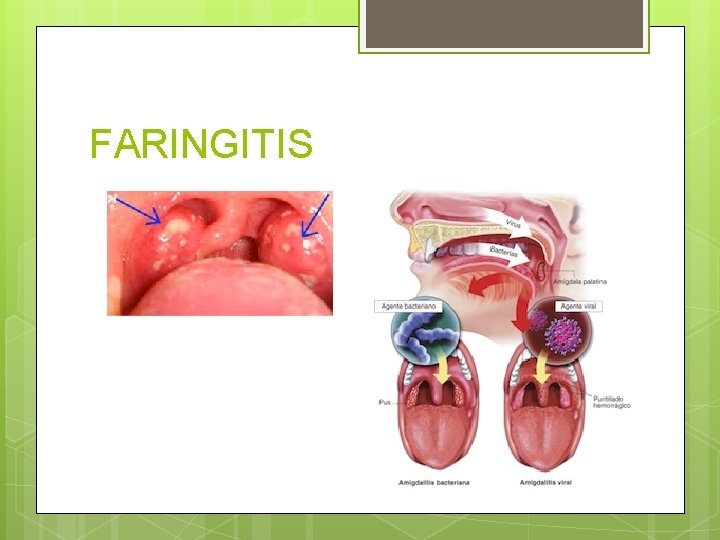 FARINGITIS FARINGITIS