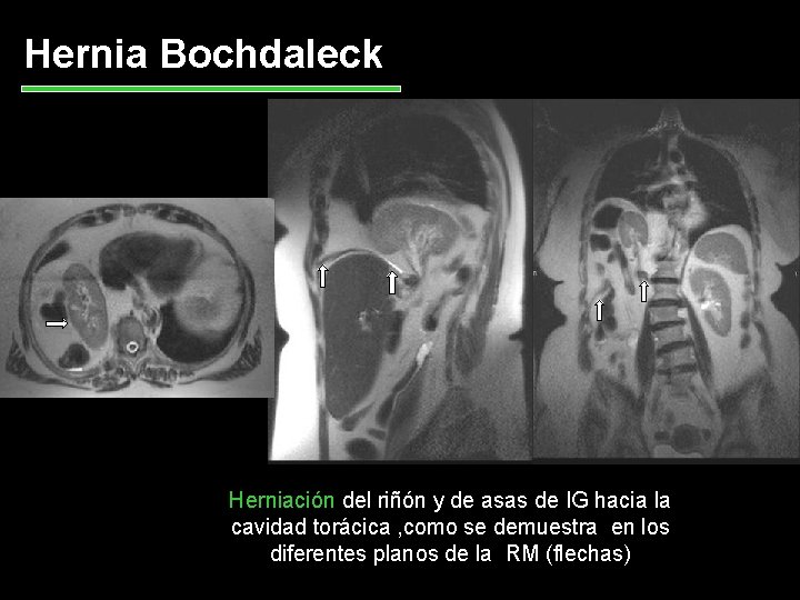 Hernia Bochdaleck Herniación del riñón y de asas de IG hacia la cavidad torácica
