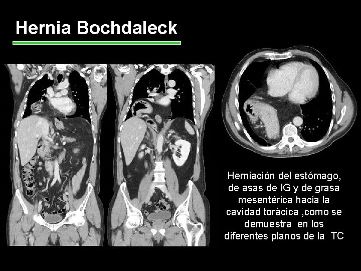 Hernia Bochdaleck Herniación del estómago, de asas de IG y de grasa mesentérica hacia