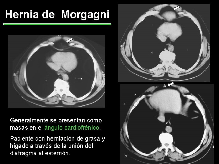 Hernia de Morgagni Generalmente se presentan como masas en el ángulo cardiofrénico. Paciente con