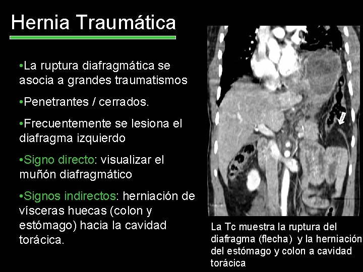 Hernia Traumática • La ruptura diafragmática se asocia a grandes traumatismos • Penetrantes /