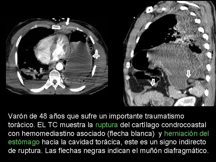Varón de 48 años que sufre un importante traumatismo torácico. EL TC muestra la