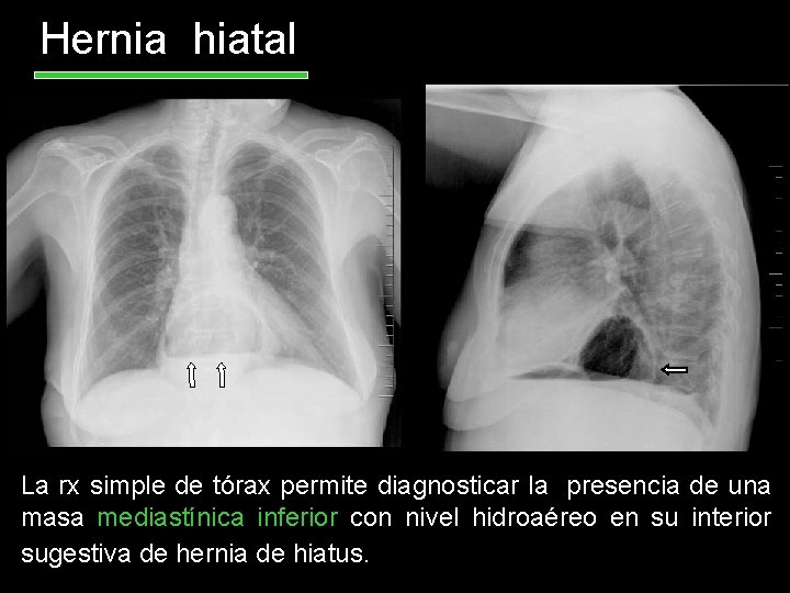 Hernia hiatal La rx simple de tórax permite diagnosticar la presencia de una masa