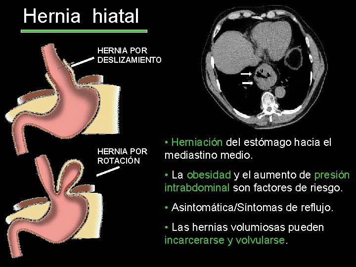Hernia hiatal HERNIA POR DESLIZAMIENTO HERNIA POR ROTACIÓN • Herniación del estómago hacia el