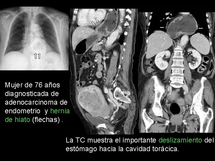 Mujer de 76 años diagnosticada de adenocarcinoma de endometrio y hernia de hiato (flechas).