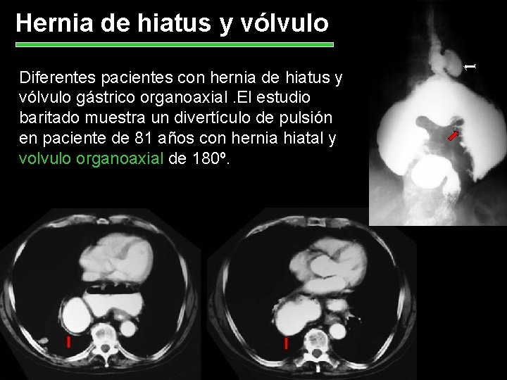 Hernia de hiatus y vólvulo Diferentes pacientes con hernia de hiatus y vólvulo gástrico