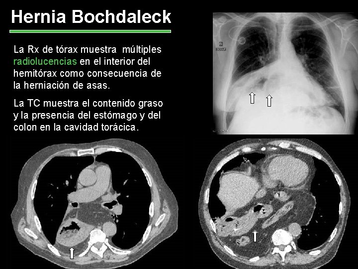 Hernia Bochdaleck La Rx de tórax muestra múltiples radiolucencias en el interior del hemitórax