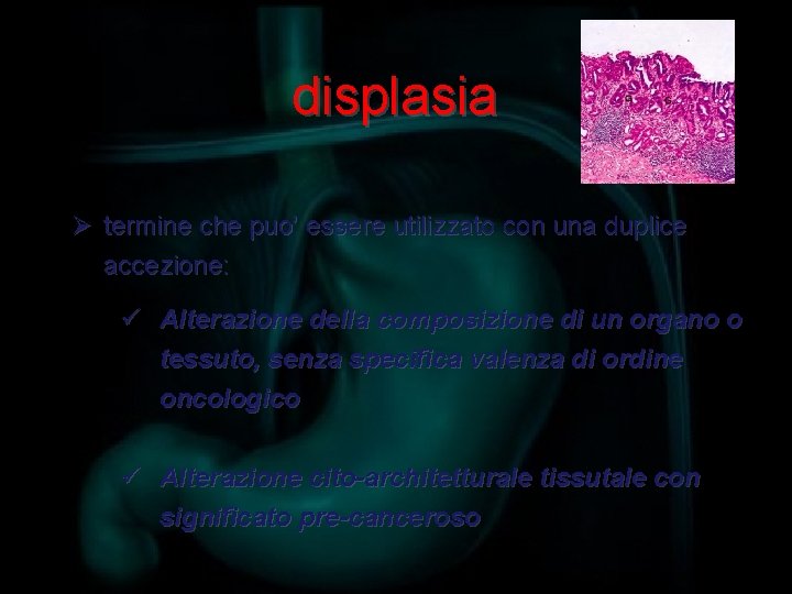 displasia Ø termine che puo’ essere utilizzato con una duplice accezione: ü Alterazione della