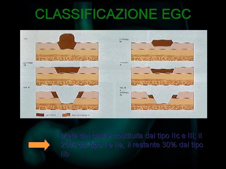 CLASSIFICAZIONE EGC Metà dei casi è costituita dal tipo IIc e III; il 20%