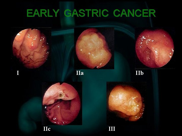EARLY GASTRIC CANCER I IIa IIc IIb III 