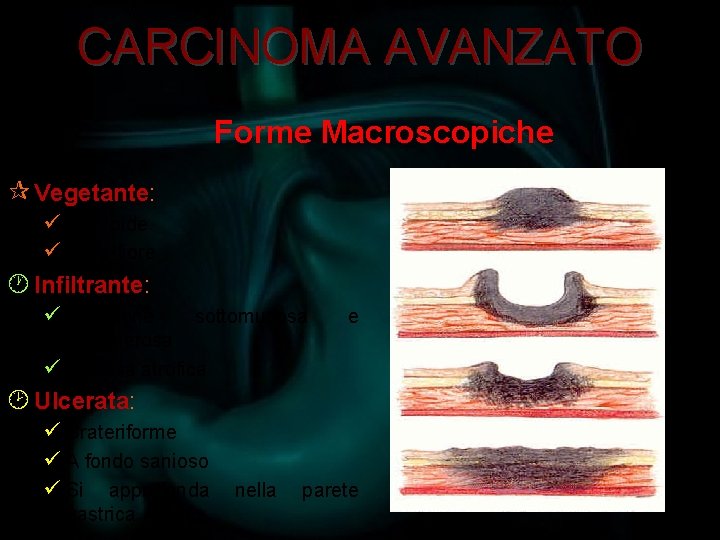 CARCINOMA AVANZATO Forme Macroscopiche ¶ Vegetante: ü Polipoide ü Cavolfiore · Infiltrante: ü Diffusione