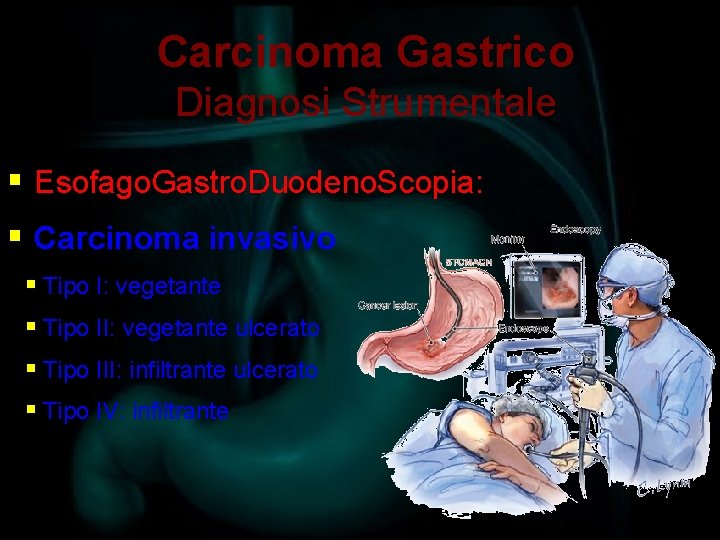 Carcinoma Gastrico Diagnosi Strumentale § Esofago. Gastro. Duodeno. Scopia: § Carcinoma invasivo § Tipo