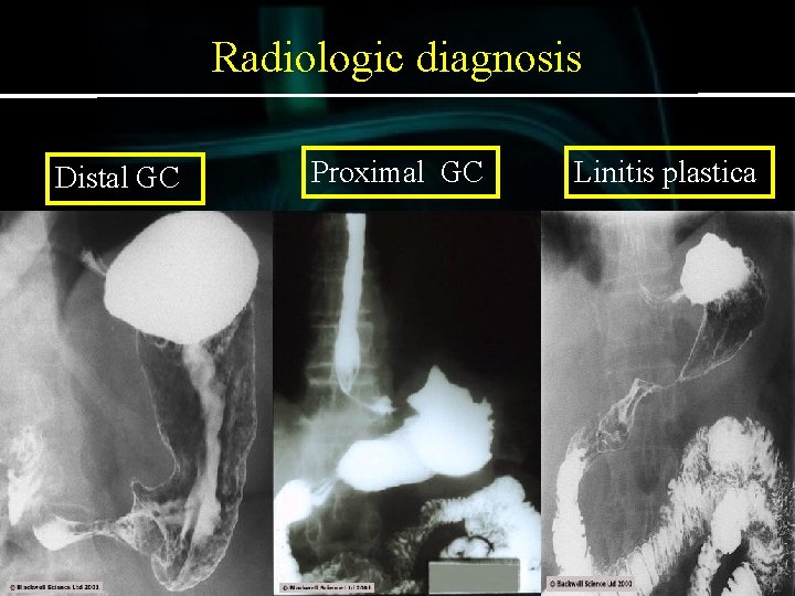 Radiologic diagnosis Distal GC Proximal GC Linitis plastica 