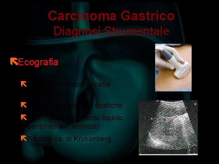 Carcinoma Gastrico Diagnosi Strumentale ëEcografia ëEvidenzia linfoadenopatie perigastriche ëRicerca di metastasi epatiche ëRicerca di