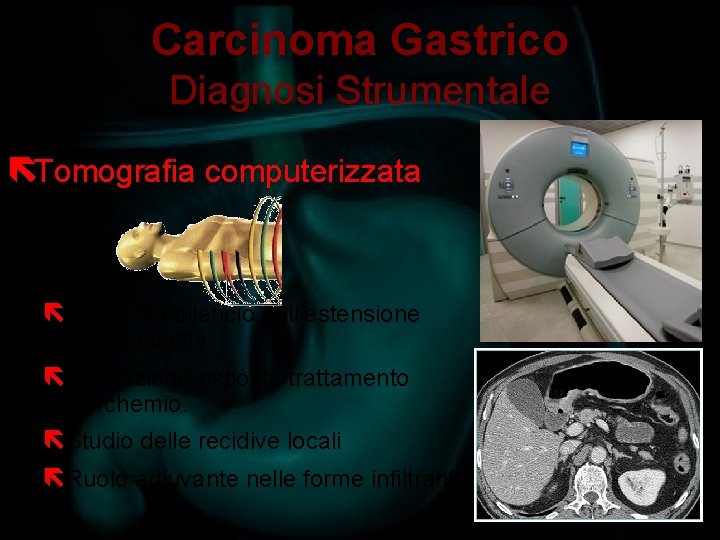Carcinoma Gastrico Diagnosi Strumentale ëTomografia computerizzata ëRuolo nel bilancio dell’estensione della malattia ëValutazione risposta